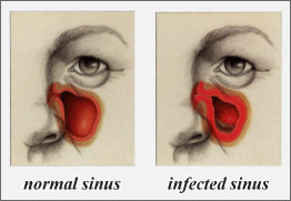 sinus_normal_infected